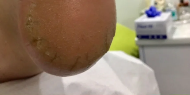 Mokrá pedikúra alebo gélové nechty na nohách