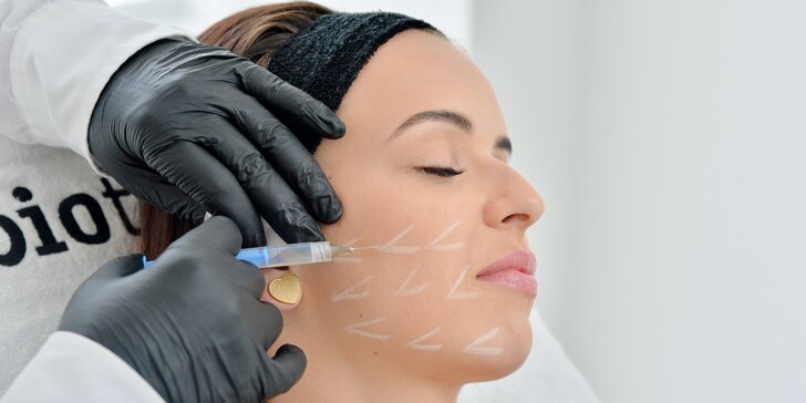 Mezoterapia tváre, očného okolia, krku, dekoltu alebo vlasov