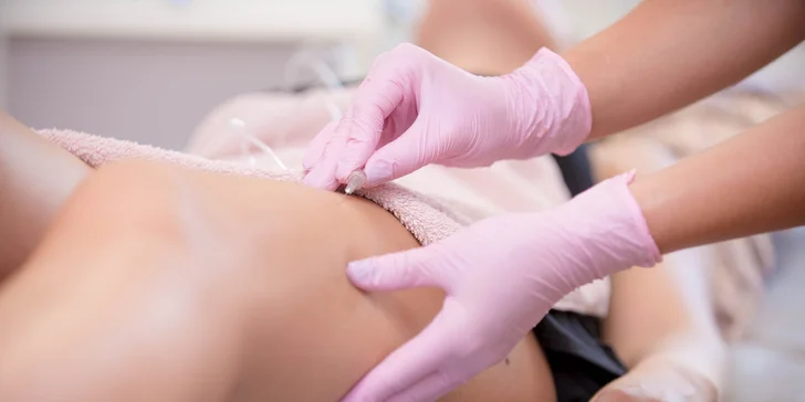 Unikátna neinvazívna karboxyterapia v BSM beauty