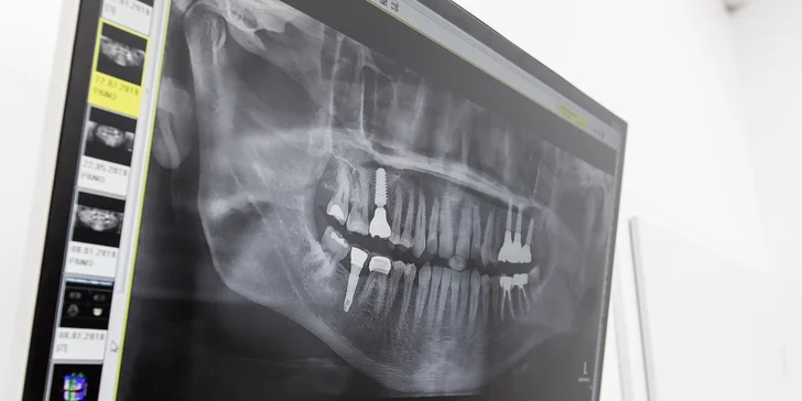 Dentálna hygiena, bielenie zubov či implantologická konzultácia + CT