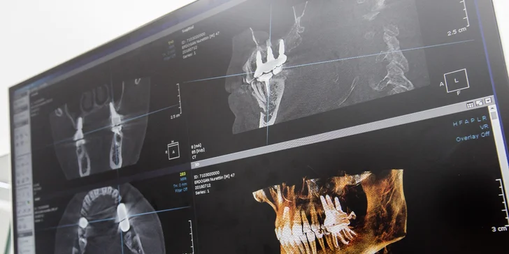 Dentálna hygiena, bielenie zubov či implantologická konzultácia + CT