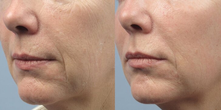 Aplikácia botoxu Bocouture na vybranú oblasť tváre či do podpazušia