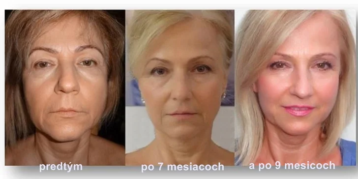 Regeneračné ošetrenie pleti s najinovatívnejšou technológiou AGE loc
