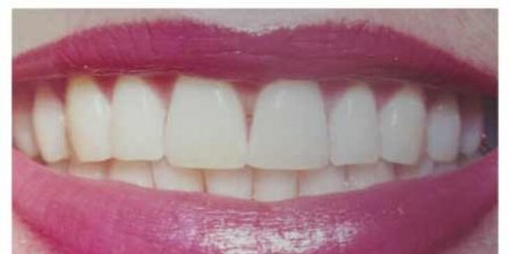 125 eur za odzbrojujúci a žiarivo biely úsmev. Profesionálne a šetrné bielenie zubov a odstránenie povlaku v ordinácii Dentálneho centra Zlatá, teraz so zľavou 50%!