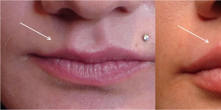 Výplň pier alebo kruhov pod očami či lifting tváre botulotoxínom