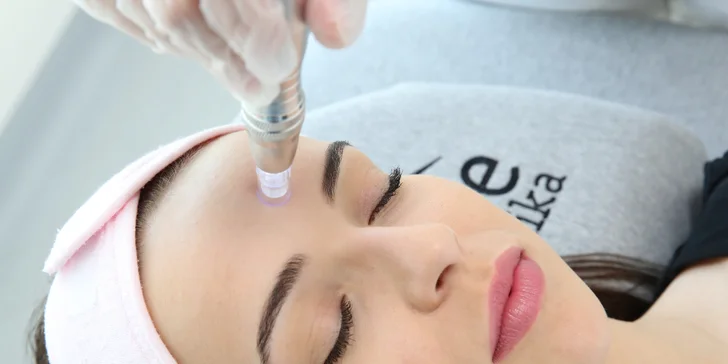 Microneedling: omladenie pleti s redukciou vrások
