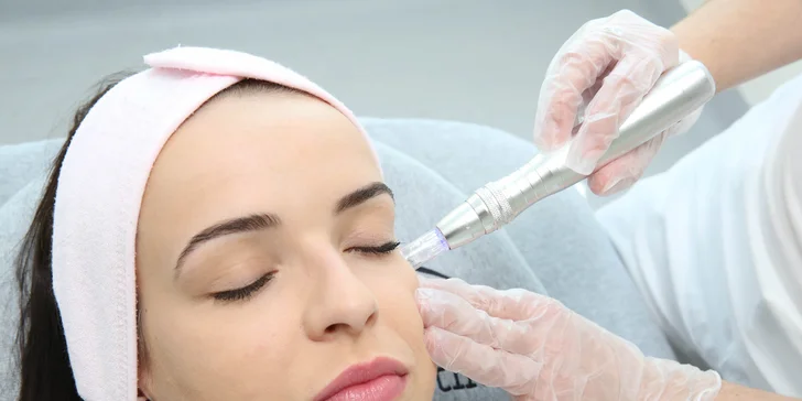 Microneedling: omladenie pleti s redukciou vrások