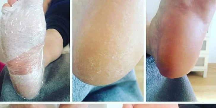 Pedikúra – mokrá s peelingom alebo masážou či gélová novinka Callux
