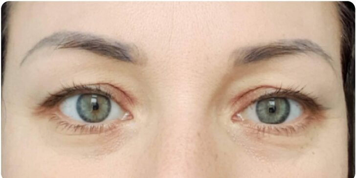 Chirurgicko-estetická úprava očných viečok s mezoterapiou na ENVY Klinike Antolská