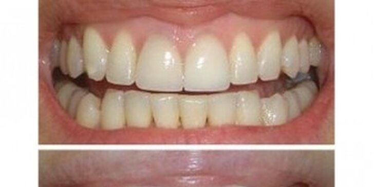 Dentálna hygiena alebo bielenie zubov