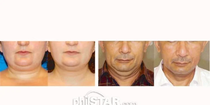 Rádiofrekvencia tváre alebo tela