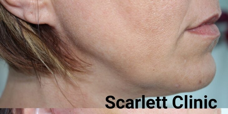 Pravý mini facelifting dolnej polovice tváre tváre v Scarlett Clinic