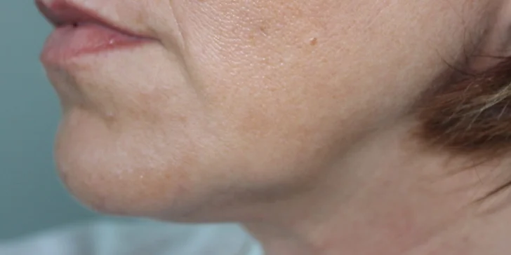 Pravý mini facelifting dolnej polovice tváre tváre v Scarlett Clinic