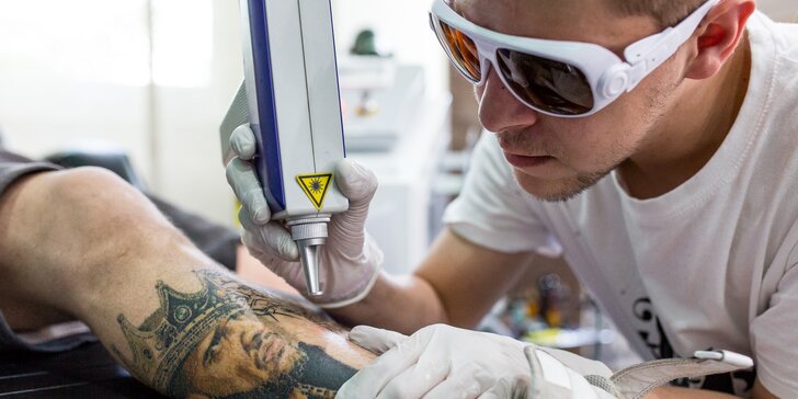 Odstránenie tetovania laserom aj so zľavou 30 % na pretetovanie