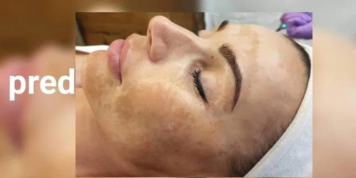 Najvyhľadávanejšie ošetrenie pre krásnu a zjednotenú pleť BB Glow!