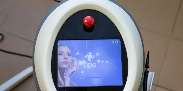 Odstraňovanie popraskaných žiliek na tvári pomocou prístrojovej termokoagulácie