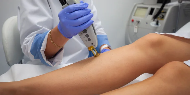 Trvalá laserová epilácia hornej pery, podpazušia, slabín či lýtok