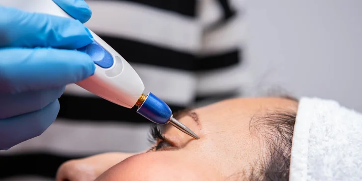 Blefaroplastika horných a dolných viečok pomocou prístroja Plaxpot
