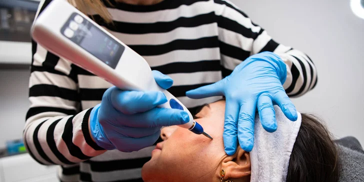 Blefaroplastika horných a dolných viečok pomocou prístroja Plaxpot