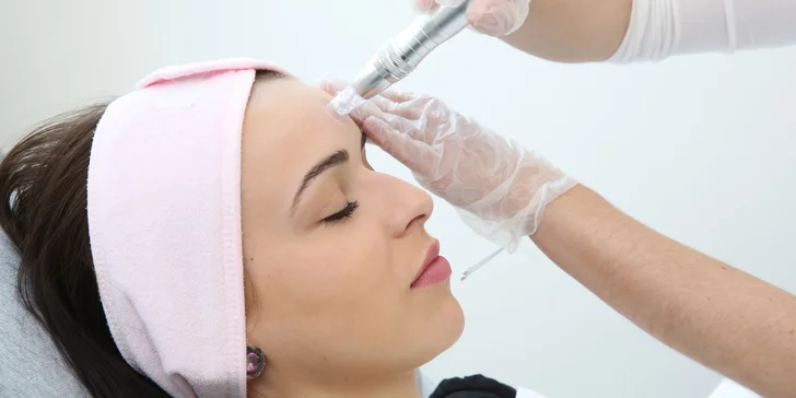 Microneedling: omladenie pleti s redukciou vrások