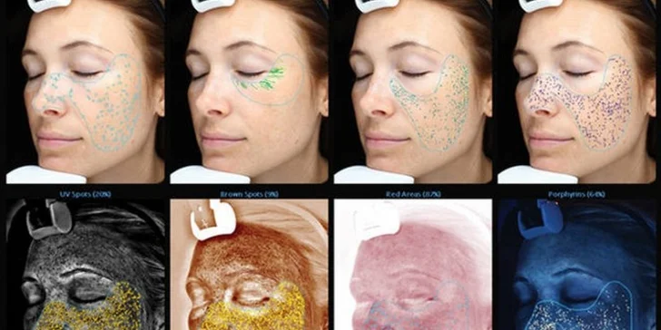 To správne riešenie pre vašu pleť - diagnostika pleti prístrojom Skin analyzér.