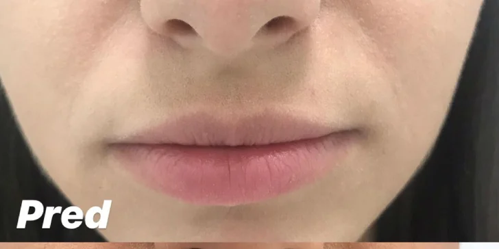Výplň kyselinou hyalurónovou vo Vivacy anti-aging centre