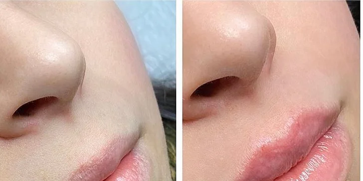 Výplň kyselinou hyalurónovou vo Vivacy anti-aging centre
