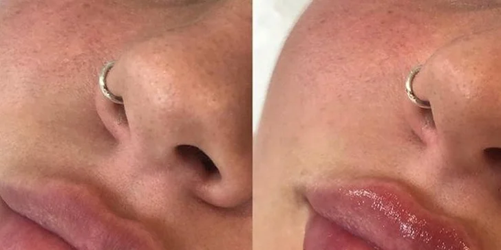 Výplň kyselinou hyalurónovou vo Vivacy anti-aging centre