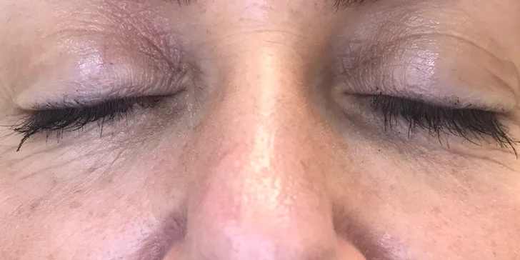 Výplň kyselinou hyalurónovou vo Vivacy anti-aging centre