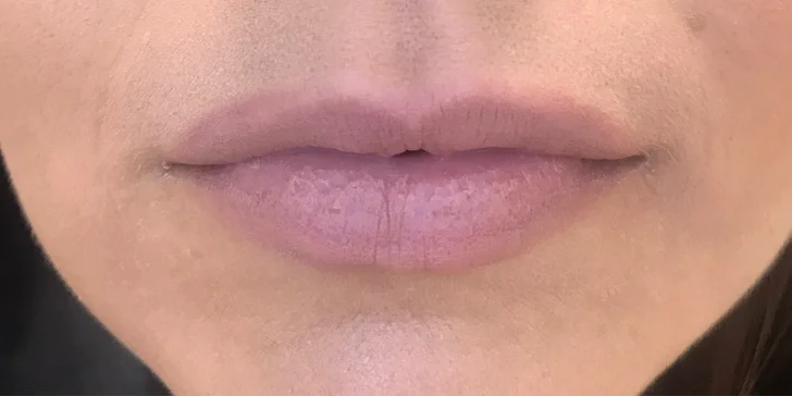 Výplň kyselinou hyalurónovou vo Vivacy anti-aging centre