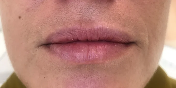 Výplň kyselinou hyalurónovou vo Vivacy anti-aging centre