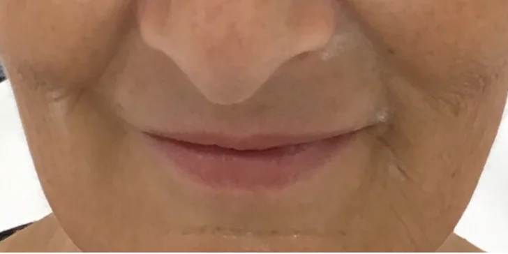 Výplň kyselinou hyalurónovou vo Vivacy anti-aging centre