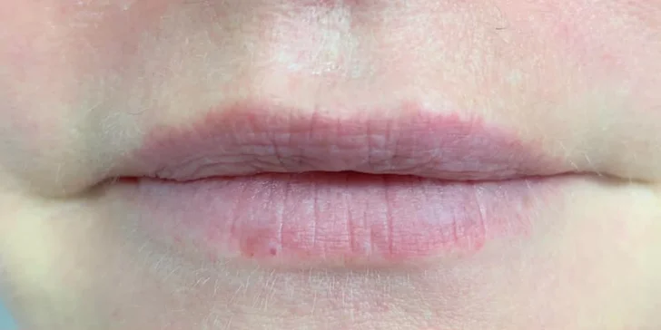Pre krásnu a vypnutú pleť: aplikácia kyseliny hyalurónovej