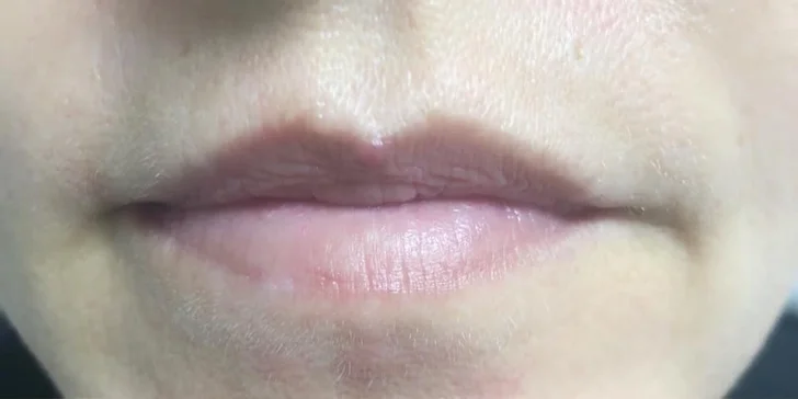Pre krásnu a vypnutú pleť: aplikácia kyseliny hyalurónovej