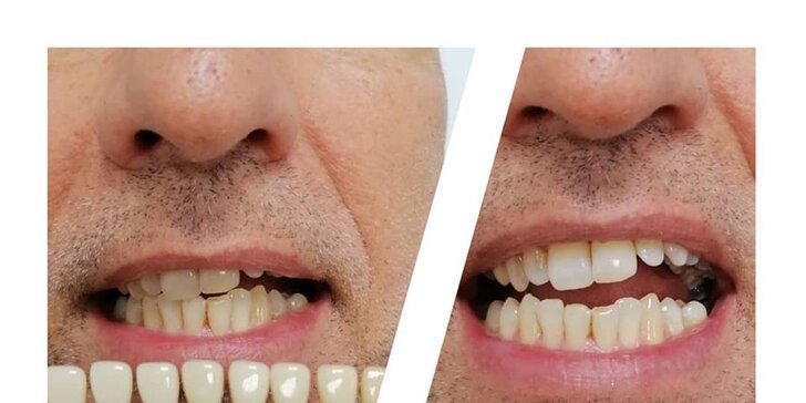 Bezperoxidové bielenie zubov až o 10 odtieňov a regenerácia zubnej skloviny v D-smile