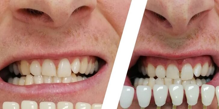 Bezperoxidové bielenie zubov až o 10 odtieňov a regenerácia zubnej skloviny v D-smile