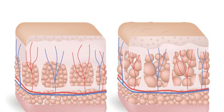 Redukcia tuku a celulitídy: medicínska podtlaková rádiofrekvencia s endomasážou a lipolaserom
