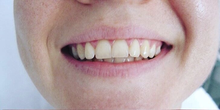 Expresné alebo kompletné laserové bielenie zubov