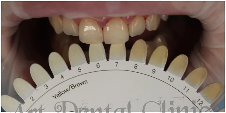 Profesionálna dentálna hygiena aj s možnosťou bielenia zubov v Art Dental Clinic
