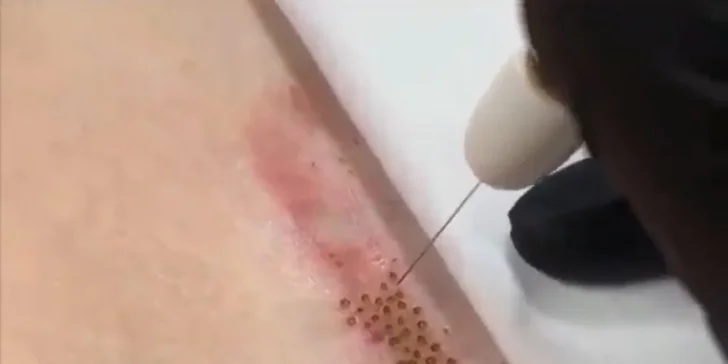Výber neinvazívnych estetických zákrokov v Dermacentrum Žilina