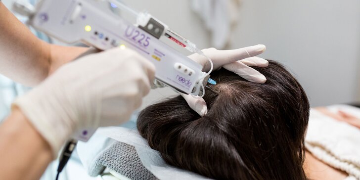 Vlasová mezoterapia na redukciu vypadávania a obnovu rastu vlasov