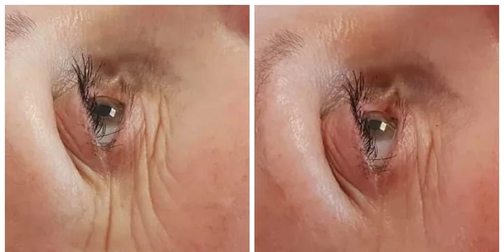 Okamžité vyhladenie vrások podľa tradičnej čínskej medicíny