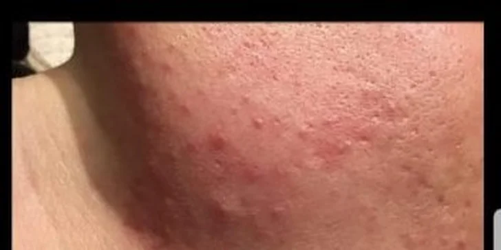 Queen therapy: Okamžité vyhladenie vrások a odstránenie akné.