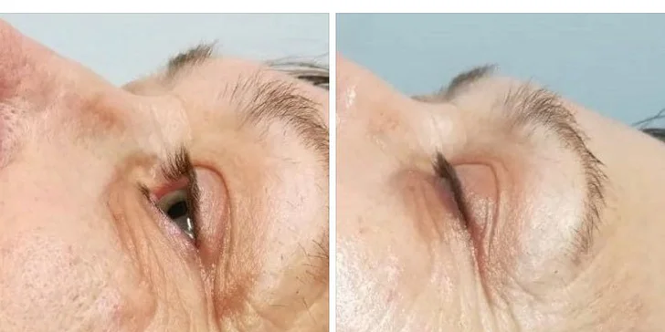 Okamžité vyhladenie vrások podľa tradičnej čínskej medicíny