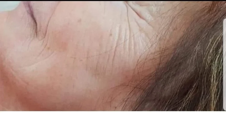 Okamžité vyhladenie vrások podľa tradičnej čínskej medicíny