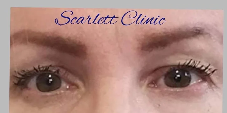 Operácia horných viečok v Scarlett clinic