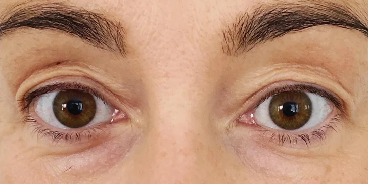 Operácia horných viečok v Scarlett clinic
