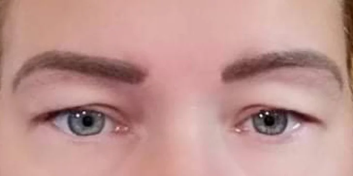 Operácia horných viečok v Scarlett clinic