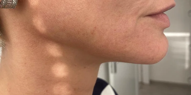 Neinvazívny lifting tváre pomocou pulznej hlavice HIFU v Scarlett Clinic
