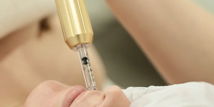 Zapracovanie kyseliny hyalúronovej masážou, dermapenom alebo výplň pier
